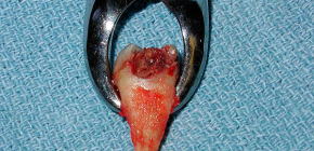 Extraction dentaire: comment préparer la procédure et ses principales étapes