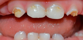Ce qu'il est important de savoir sur la carie des dents à feuilles caduques chez les jeunes enfants