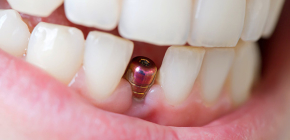 Combien de temps un implant dentaire sert-il habituellement et combien de temps peut-il être remplacé