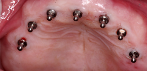 L'utilisation de mini-implants pour réparer les prothèses dentaires