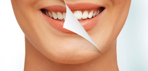 Quel blanchiment dentaire est le plus sûr et le plus doux pour l'émail?