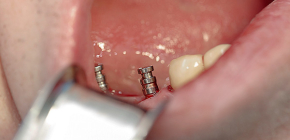 Types d'implants dentaires modernes et prix standard pour cette procédure