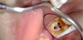 À propos du traitement de la pulpite des dents à trois canaux et des prix de cette procédure