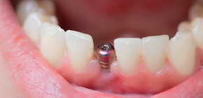 Ce qui est inclus dans l'implantation dentaire clé en main et ce qui devra être payé séparément
