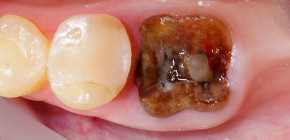 Enlèvement des racines de la dent (lorsque la partie de la couronne est détruite ou inflammation à la racine)