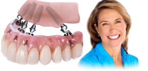 Technologies de prothèse dentaire All-on-4 et All-on-6: similitudes et différences