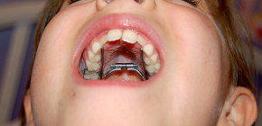 Appareils orthodontiques pour la correction des morsures chez les enfants