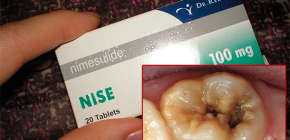 Utiliser des pilules Nise pour soulager les maux de dents