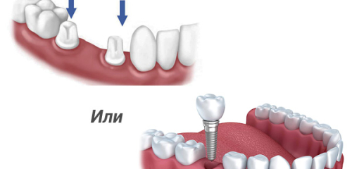 Quel est le meilleur: bridge dentaire ou implant?