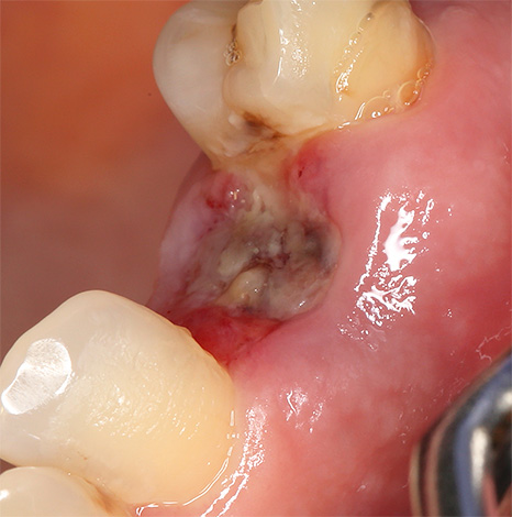 Parlons de l'alvéolite - une complication désagréable qui survient souvent après l'extraction dentaire et se manifeste par une inflammation et une suppuration du trou, ce qui réduit le taux de guérison.