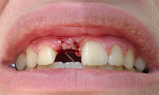 Même si le trou dentaire après l'auto-traitement a cessé de s'aggraver, vous devriez toujours demander l'avis d'un dentiste.