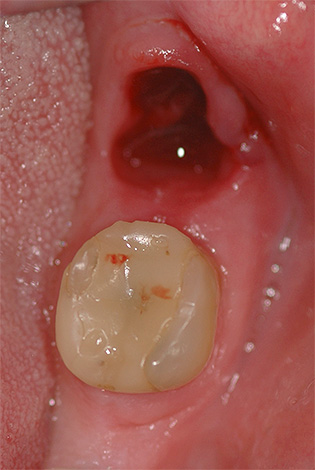 L'alvéolite peut être traitée à domicile, mais dans la plupart des cas, une visite chez le dentiste sera toujours nécessaire.