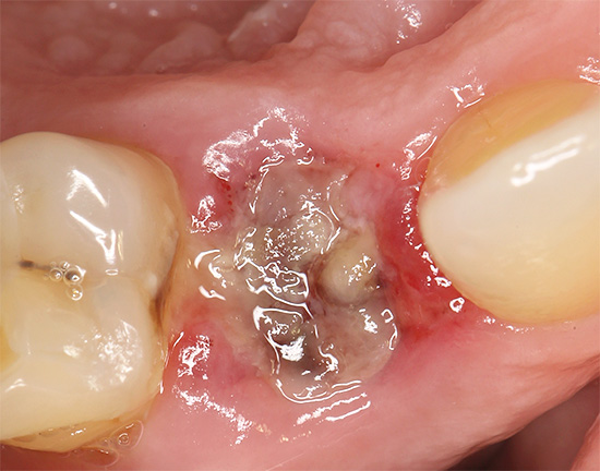La photo montre l'apparence du trou 2 jours après l'extraction dentaire.