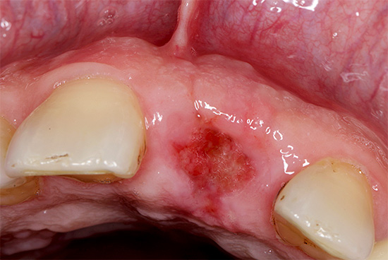 L'apparition du trou après 3 semaines à partir du moment de l'extraction dentaire - la gencive a pratiquement guéri.