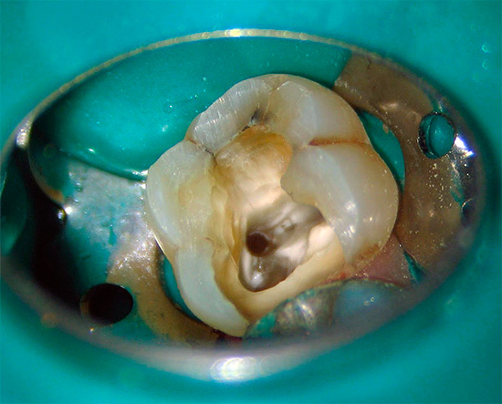 Dans les cliniques coûteuses, le batardeau est utilisé pour isoler une dent malade de la cavité buccale.