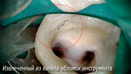 La photo montre un morceau d'un fragment d'un instrument dentaire extrait d'un canal.