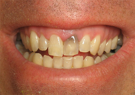 Parfois, après avoir traité une pulpite, la dent peut s'assombrir beaucoup.