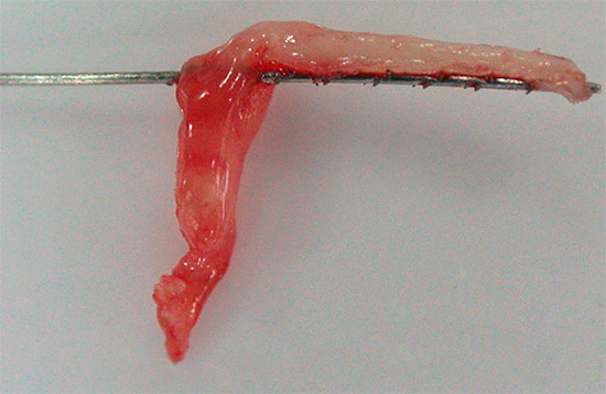 Photographie d'un nerf retiré d'une dent (pulpe)