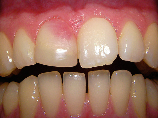 Et voici un exemple d'une dent rose, dont la couleur est apparue en raison de l'utilisation de pâte de résorcinol-formol dans le traitement du canal.