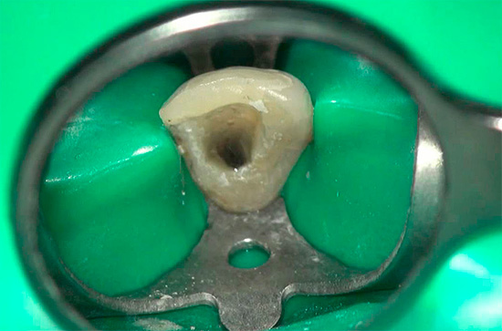 En règle générale, le prix minimum n'est obtenu que dans le traitement de la pulpite d'une dent à canal unique.