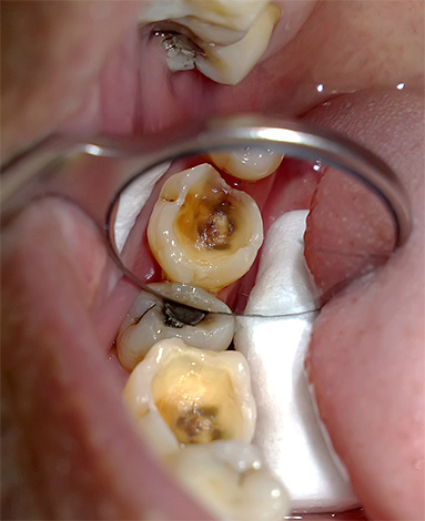 La photo montre une dent carieuse préparée pour un traitement endodontique.