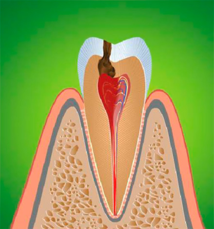 L'inflammation du nerf dentaire entraîne une pulpite, qui s'accompagne généralement de douleurs aiguës.