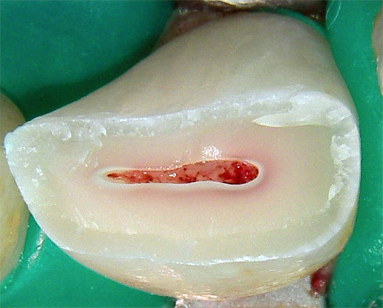 La photo montre une dent cassée - vous devrez également en retirer le nerf.