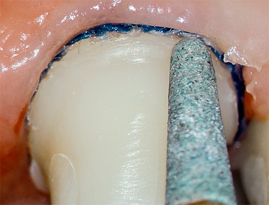 Pendant le grincement de la dent sous la couronne, le nerf à l'intérieur peut surchauffer, ce qui entraîne par la suite une pulpite.