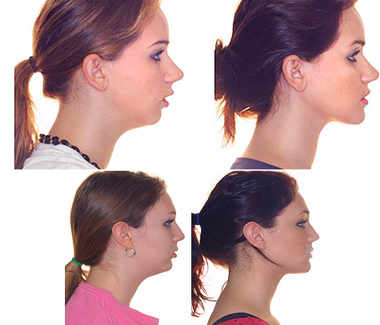 Après traitement (correction) de la morsure distale, la forme de la mâchoire inférieure subit des changements importants.