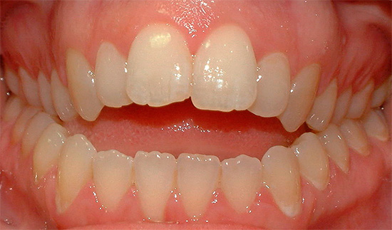 Lorsque les dents de la partie antérieure ne se ferment pas, elles parlent d'une morsure ouverte.