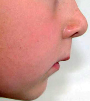 Avec une morsure profonde, l'un des signes caractéristiques est un raccourcissement significatif du tiers inférieur du visage.