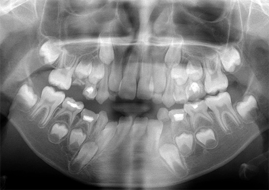 Orthopantomogramme chez un enfant (photo panoramique de la dentition).