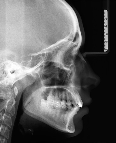 Le télé-radiogramme de la tête aide l'orthodontiste à tirer une conclusion sur les causes du développement de l'une ou l'autre malocclusion.