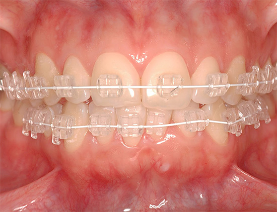 Les croisillons en saphir sont parmi les plus invisibles sur les dents.