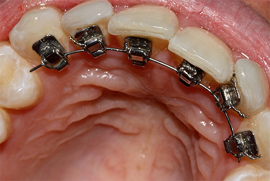 Les appareils orthopédiques linguaux sont attachés au côté intérieur (lingual) des dents, ils sont donc invisibles aux autres.