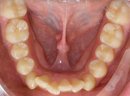 L'une des anomalies de morsure les plus courantes est l'encombrement des dents.