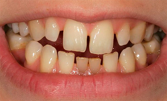 La cause de l'apparition de trois (lacunes) peut être la microdentie - la petite taille des dents individuelles d'affilée.