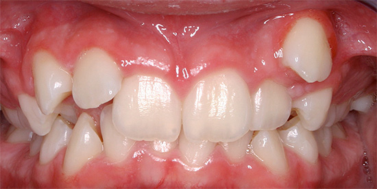 Parfois, une dent peut éclater dans un endroit atypique pour elle, ce qui conduit finalement à la formation d'une malocclusion.