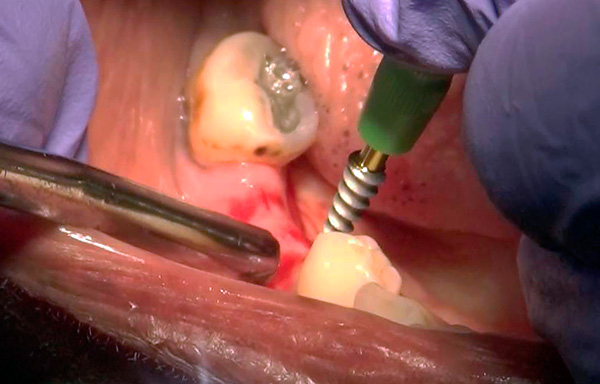 Les implants basaux peuvent souvent être installés sans incisions gingivales importantes - la méthode de la soi-disant ponction (incision circulaire).