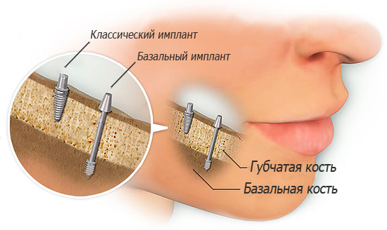 Les implants basaux sont placés dans l'os basal dense de la mâchoire.