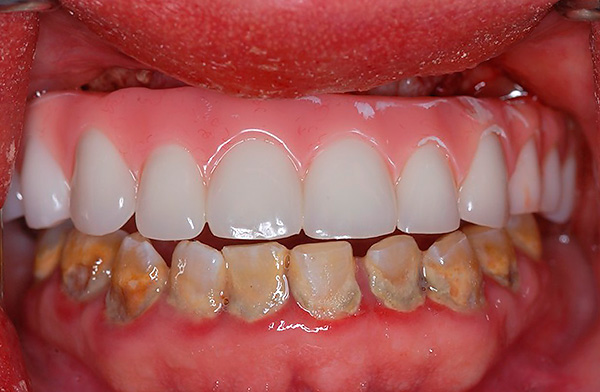 Les prothèses sur implants basaux sont possibles même si le patient présente des formes sévères de parodontite et de maladie parodontale.