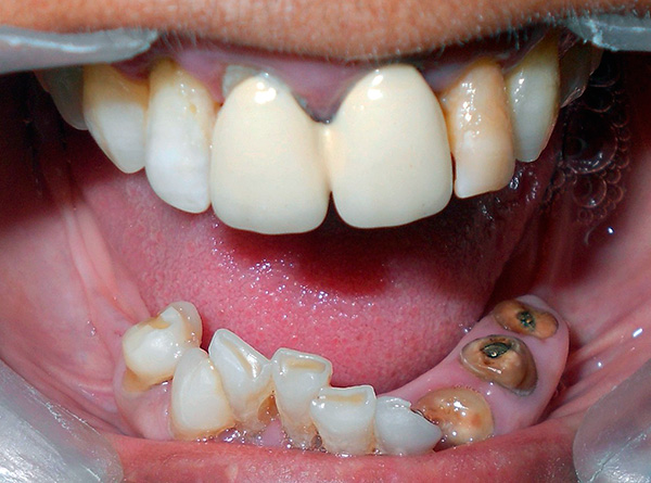 Une indication pour l'implantation basale est l'absence de dents en quantité supérieure à 3.