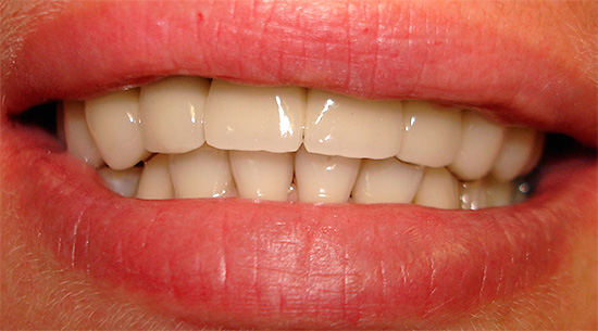 Avec des soins bucco-dentaires appropriés, le cermet peut vous durer plus de 10 ans et peut-être toute votre vie.
