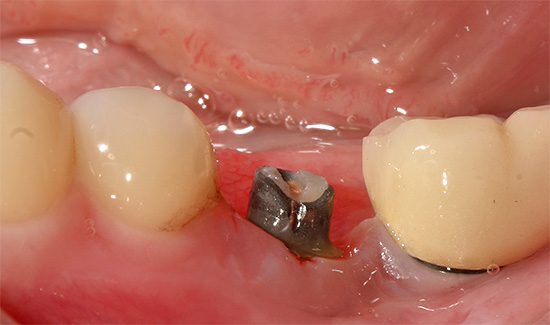 L'inflammation dans la zone d'un implant installé est appelée péri-implantite.