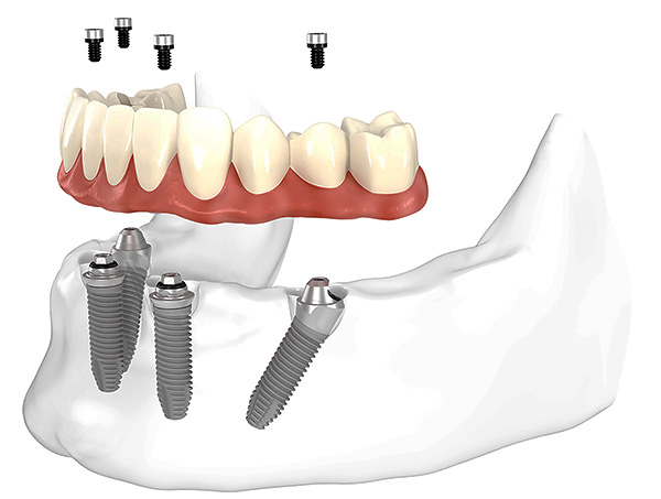 La photo montre schématiquement les prothèses des dents en utilisant la méthode All-on-4 (sur quatre implants).