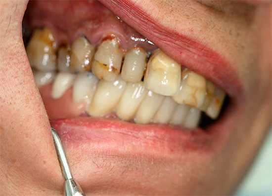 Avant la procédure, l'état de la cavité buccale et de la mâchoire du patient est soigneusement examiné.