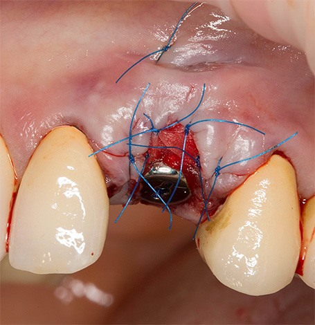 Après l'implantation, des sutures sont placées sur la gencive.