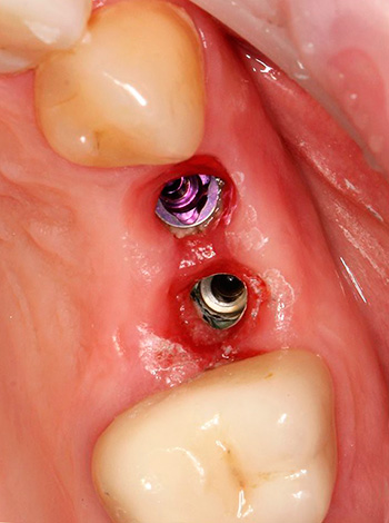 La périimplantite est une inflammation dans le domaine des implants dentaires établis.