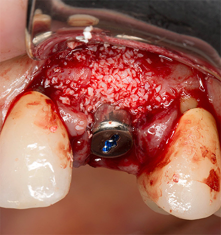 La photo montre un exemple de pose d'implant avec greffe osseuse.