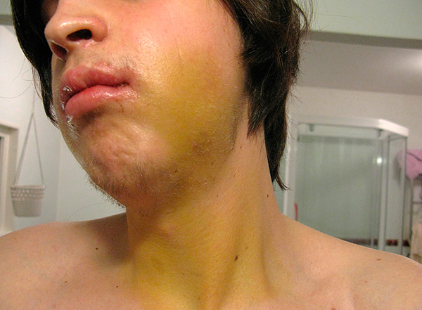 Parfois, après avoir installé des implants sur le visage et même le cou, un hématome peut être observé.